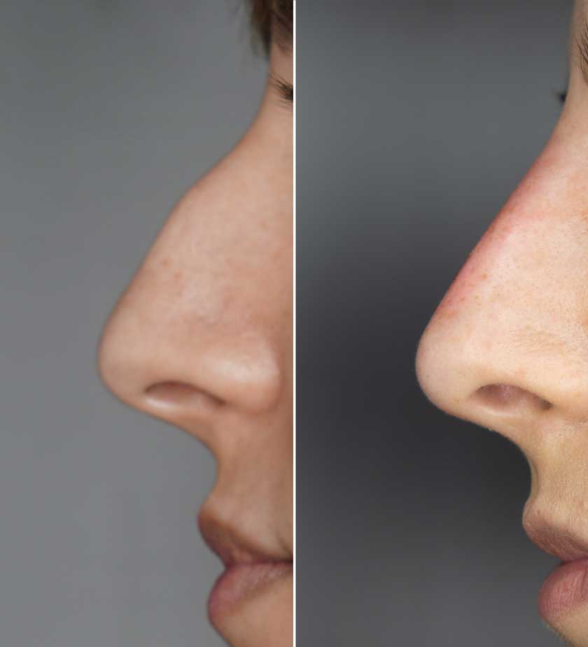 Botox-viersen-Nasenkorrektur-ohne-op-nase-begradigen-Mönchengladbach-Magdalena-nadurska-Korschenbroich-Willich-Wegberg-Kaarst-Tönisvorst-Erkelenz